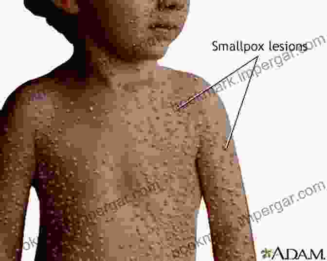 A Depiction Of A Smallpox Victim, With Visible Pustules On The Face And Body. When Germs Travel: Six Major Epidemics That Have Invaded America And The Fears They Have Unleashed