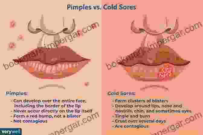 Cold Sore Breakouts And Herpes Virus How To Stop Cold Sore Outbreaks And Hsv 1 While Getting Youthful Skin