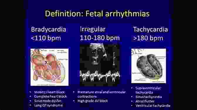 Fetal Arrhythmia Diagnosis And Management Diagnosis And Management Of Fetal Arrhythmias