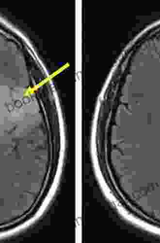 Diffuse Low Grade Gliomas In Adults